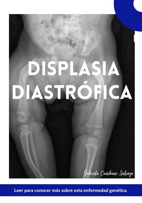 displasia diastrófica